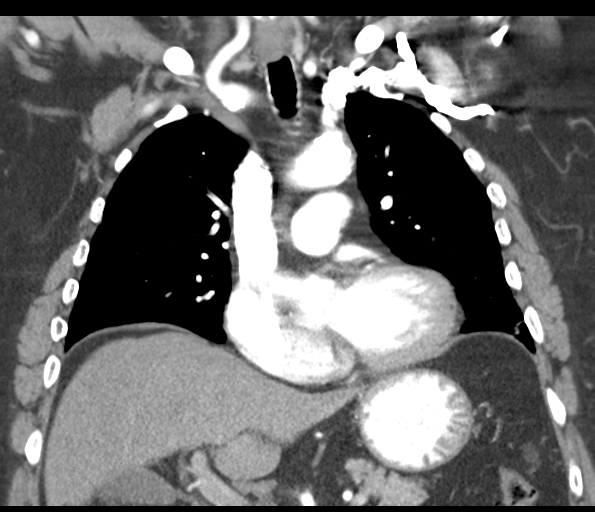 Adenocarcioma of rectum- T1 lesion (Radiopaedia 36921-38547 Coronal C+ arterial phase 29).png