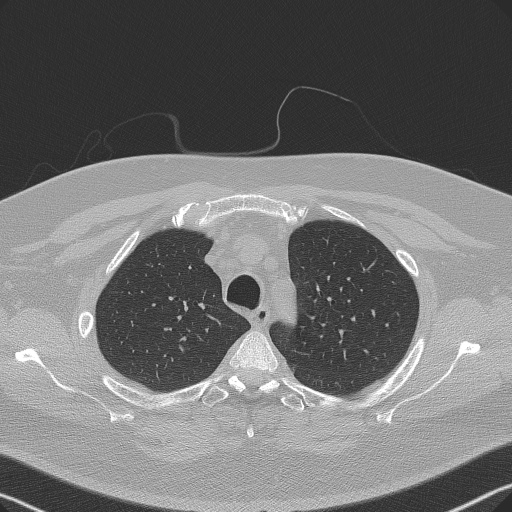 Adenoid cystic carcinoma of the trachea (Radiopaedia 49042-54137 Axial lung window 79).jpg