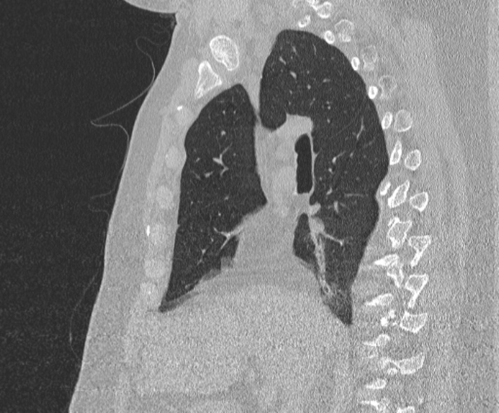 Adenoid cystic carcinoma of the trachea (Radiopaedia 49042-54137 Sagittal lung window 199).jpg