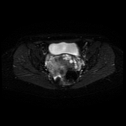 File:Adenoma malignum of cervix (Radiopaedia 66441-75705 Axial DWI 11).jpg