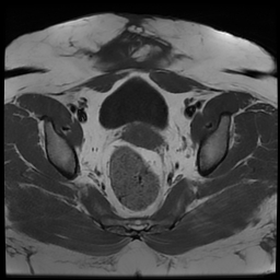 File:Adenomyosis within a didelphys uterus (Radiopaedia 70175-80215 Axial T1 27).jpg