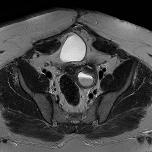 File:Adenomyosis within a didelphys uterus (Radiopaedia 70175-80215 Axial T2 15).jpg