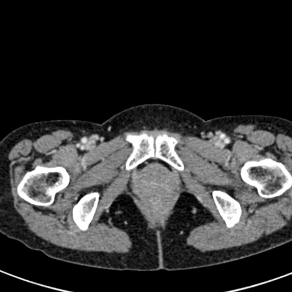 Adhesional small bowel obstruction (Radiopaedia 48397-53305 Axial C+ portal venous phase 97).jpg