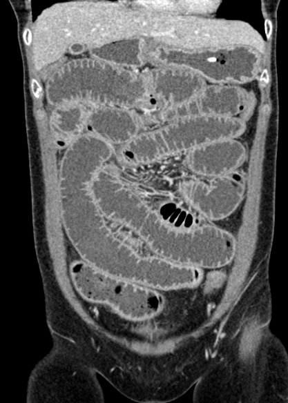 Adhesional small bowel obstruction (Radiopaedia 48397-53305 Coronal C+ portal venous phase 102).jpg