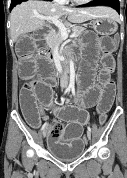 File:Adhesional small bowel obstruction (Radiopaedia 48397-53305 Coronal C+ portal venous phase 156).jpg