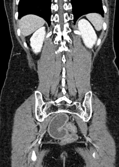 Adhesional small bowel obstruction (Radiopaedia 48397-53305 Coronal C+ portal venous phase 283).jpg