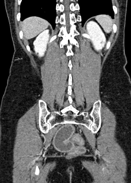 Adhesional small bowel obstruction (Radiopaedia 48397-53305 Coronal C+ portal venous phase 285).jpg