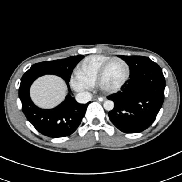 Adhesional small bowel obstruction (Radiopaedia 52107-57980 Axial C+ portal venous phase 3).jpg