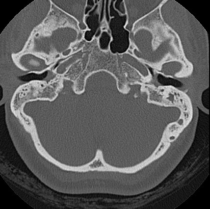 File:Adhesive chronic otitis media (Radiopaedia 14270-14148 Axial bone window 12).jpg