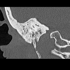 File:Adhesive chronic otitis media (Radiopaedia 14270-14148 Coronal bone window - right 18).jpg