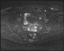 Adnexal multilocular cyst (O-RADS US 3- O-RADS MRI 3) (Radiopaedia 87426-103754 Axial DWI 47).jpg