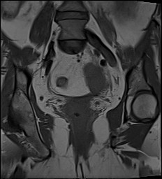 File:Adnexal multilocular cyst (O-RADS US 3- O-RADS MRI 3) (Radiopaedia 87426-103754 Coronal 19).jpg