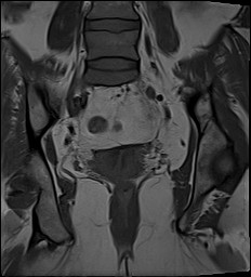 File:Adnexal multilocular cyst (O-RADS US 3- O-RADS MRI 3) (Radiopaedia 87426-103754 Coronal 21).jpg
