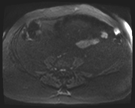 Adrenal cortical carcinoma (Radiopaedia 64017-72770 Axial DWI 128).jpg