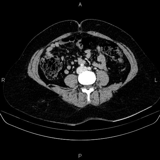 Adrenal cortical carcinoma (Radiopaedia 84882-100379 Axial C+ portal venous phase 56).jpg