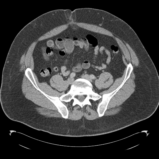 Adrenal cyst (Radiopaedia 45625-49776 Axial C+ portal venous phase 69).png