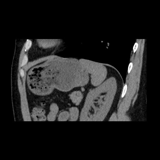 Adrenal gland trauma (Radiopaedia 81351-95079 Sagittal non-contrast 75).jpg
