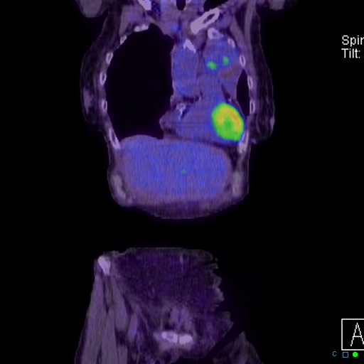 File:Adrenal metastasis from small cell lung cancer (Radiopaedia 19133-19109 Coronal 2).jpg