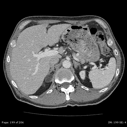 File:Adrenal myelolipoma (Radiopaedia 23636-23764 C 1).jpg