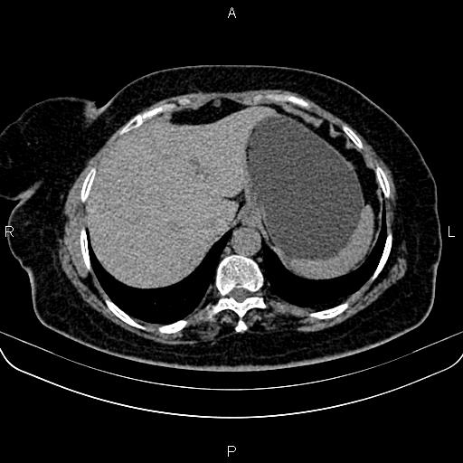 Adrenal myelolipoma (Radiopaedia 82742-96986 Axial non-contrast 21).jpg