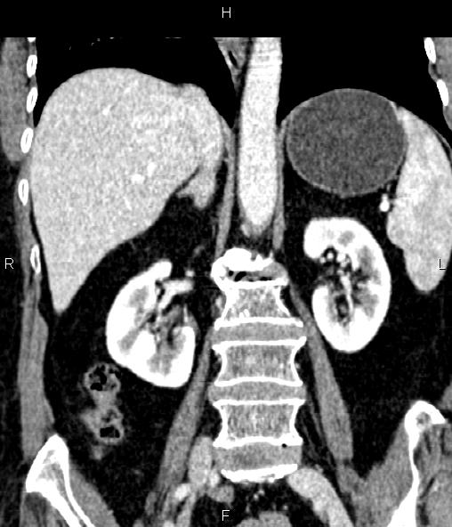 Adrenal myelolipoma (Radiopaedia 82742-96986 Coronal renal cortical phase 46).jpg