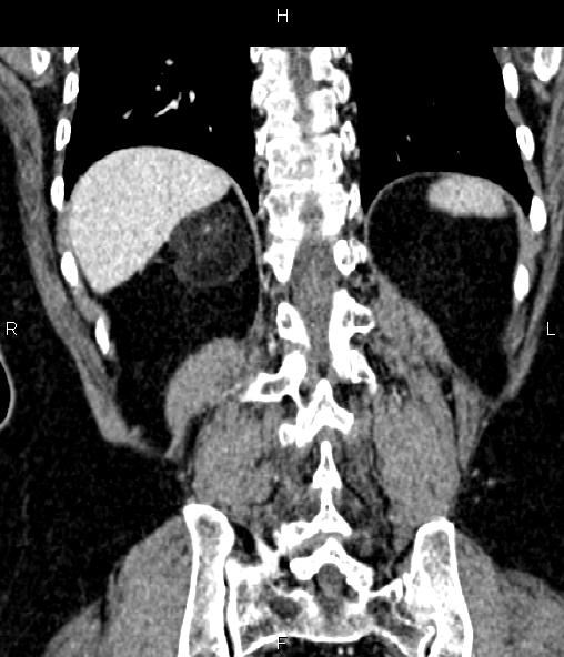 File:Adrenal myelolipoma (Radiopaedia 82742-96986 Coronal renal cortical phase 60).jpg