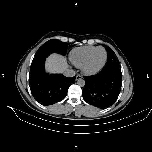 Adrenal myelolipoma (Radiopaedia 87794-104246 Axial non-contrast 11).jpg