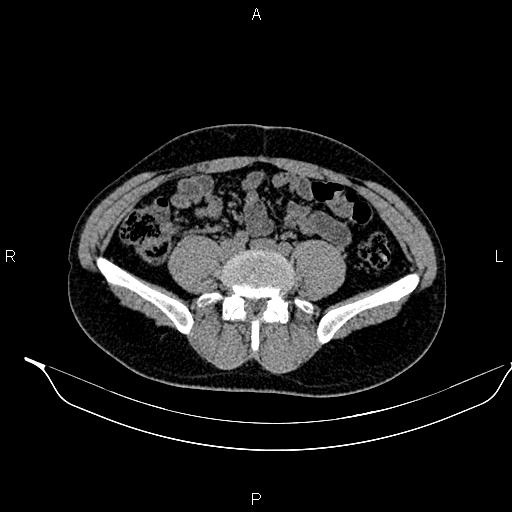 Adrenal myelolipoma (Radiopaedia 87794-104246 Axial non-contrast 70).jpg