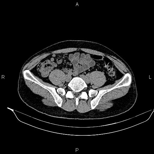 Adrenal myelolipoma (Radiopaedia 87794-104246 Axial non-contrast 75).jpg