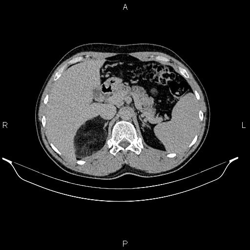 Adrenal myelolipoma (Radiopaedia 87794-104246 Axial renal excretory phase 27).jpg