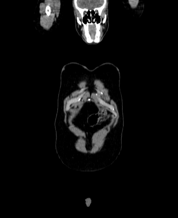Adrenocortical carcinoma (Radiopaedia 80134-93438 Coronal C+ portal venous phase 16).jpg
