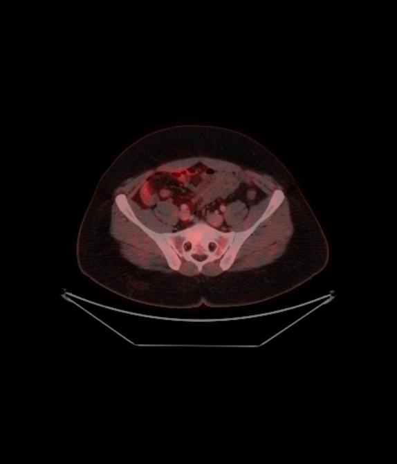 Adrenocortical carcinoma (Radiopaedia 80134-93440 ِAxial 221).jpg