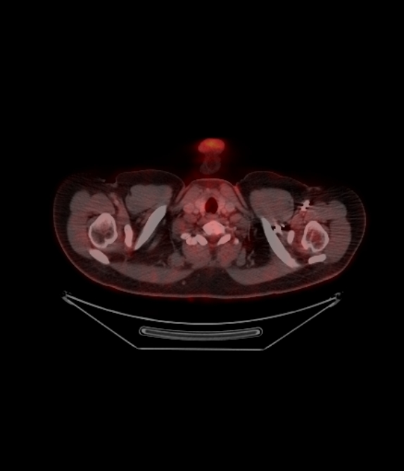 Adrenocortical carcinoma (Radiopaedia 80134-93440 ِAxial 80).jpg