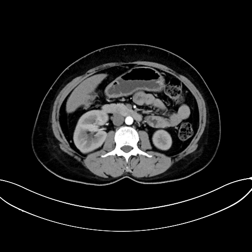 Adrenocortical carcinoma (Radiopaedia 87281-103569 Axial C+ arterial phase 41).jpg