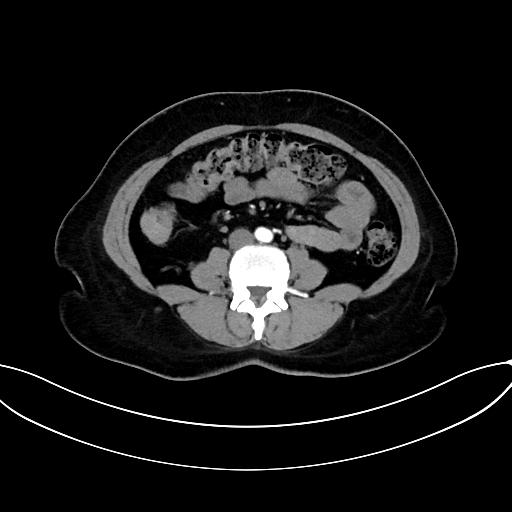 Adrenocortical carcinoma (Radiopaedia 87281-103569 Axial C+ arterial phase 51).jpg