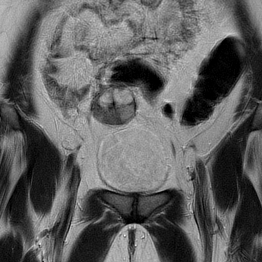 File:Adult granulosa cell tumor of the ovary (Radiopaedia 64991-73953 Coronal T2 4).jpg