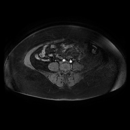 File:Adult granulosa cell tumor of the ovary (Radiopaedia 64991-73953 axial-T1 Fat sat post-contrast dynamic 25).jpg