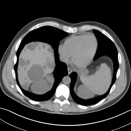 Adult polycystic kidney disease (Radiopaedia 47866-52626 Axial non-contrast 6).png