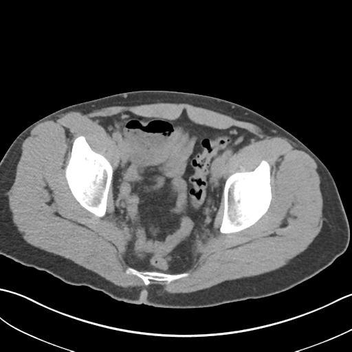File:Adult polycystic kidney disease (Radiopaedia 47866-52626 Axial non-contrast 75).png