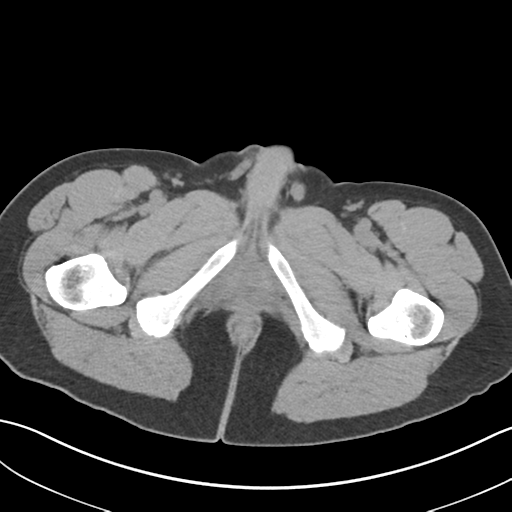 File:Adult polycystic kidney disease (Radiopaedia 47866-52626 Axial non-contrast 93).png