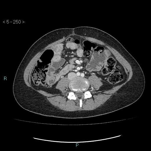 Adult transient intestinal intussusception (Radiopaedia 34853-36310 Axial C+ portal venous phase 53).jpg
