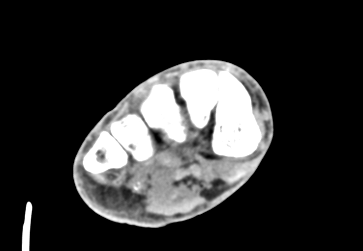 Advanced osteomyelitis due to open metatarsal fracture (Radiopaedia 83891-99095 Axial non-contrast 25).jpg