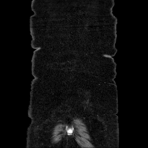 File:Afferent loop syndrome - secondary to incarcerated trocar site hernia (Radiopaedia 82959-97305 Coronal C+ portal venous phase 138).jpg