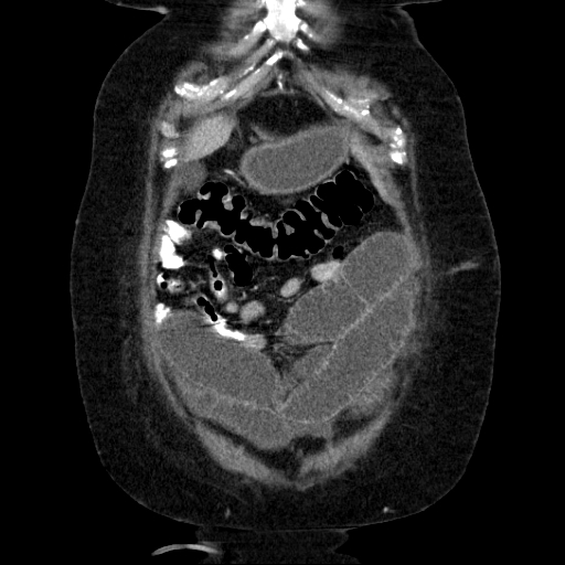 File:Afferent loop syndrome - secondary to incarcerated trocar site hernia (Radiopaedia 82959-97305 Coronal C+ portal venous phase 40).jpg