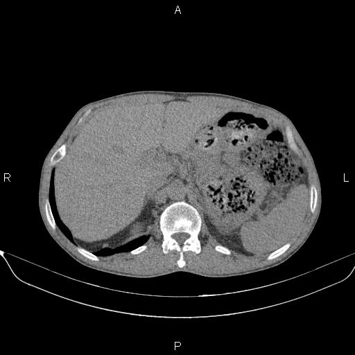 Air bronchogram in pneumonia (Radiopaedia 85719-101512 Axial non-contrast 69).jpg