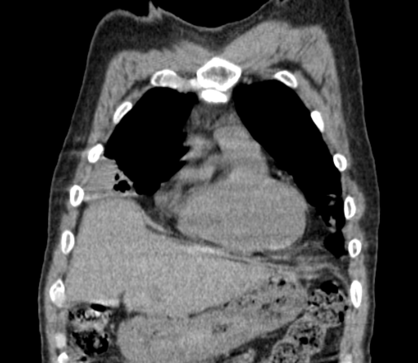 Airway foreign body in adult (Radiopaedia 85907-101779 Coronal liver window 49).jpg