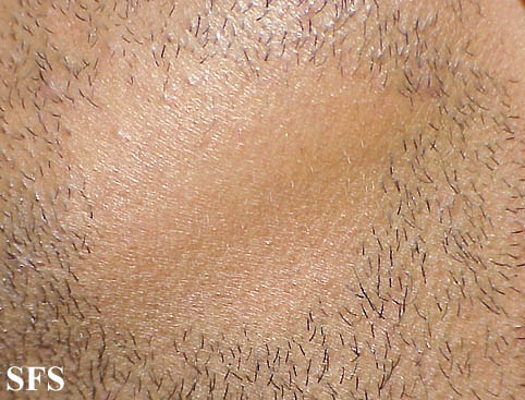 Alopecia Areata (Dermatology Atlas 2).jpg