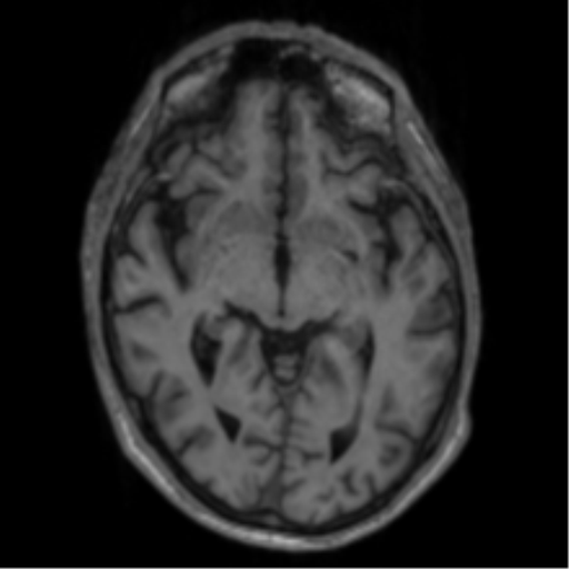 File:Alzheimer's disease- with apraxia (Radiopaedia 54763-61011 Axial T1 34).png