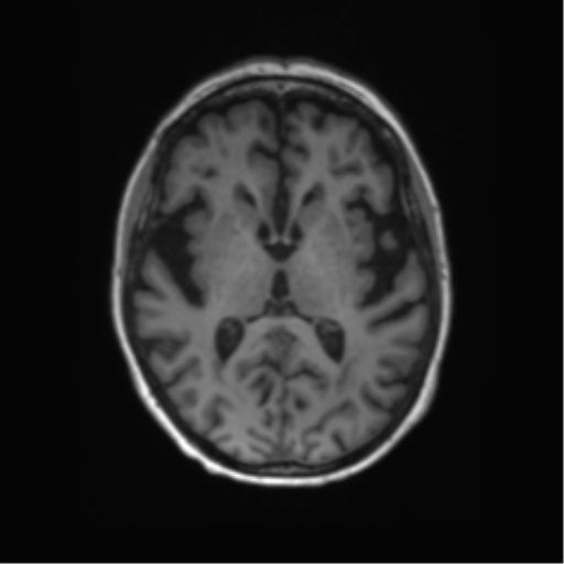 File:Alzheimer's disease (Radiopaedia 42658-45802 Axial T1 79).png