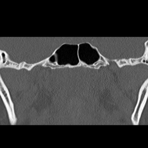 File:Ameloblastic fibro-odontoma (Radiopaedia 18843-18780 B 27).jpg